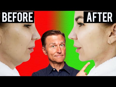 Fastest Way to Rid Your DOUBLE CHIN (Turkey Neck)