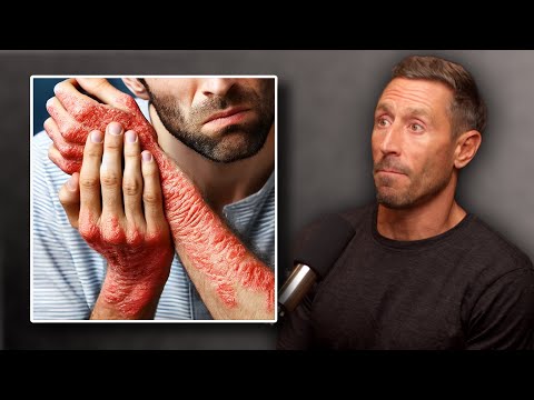 The True Cause of Eczema & How to Heal